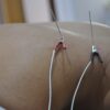 punción seca en córdoba terapia